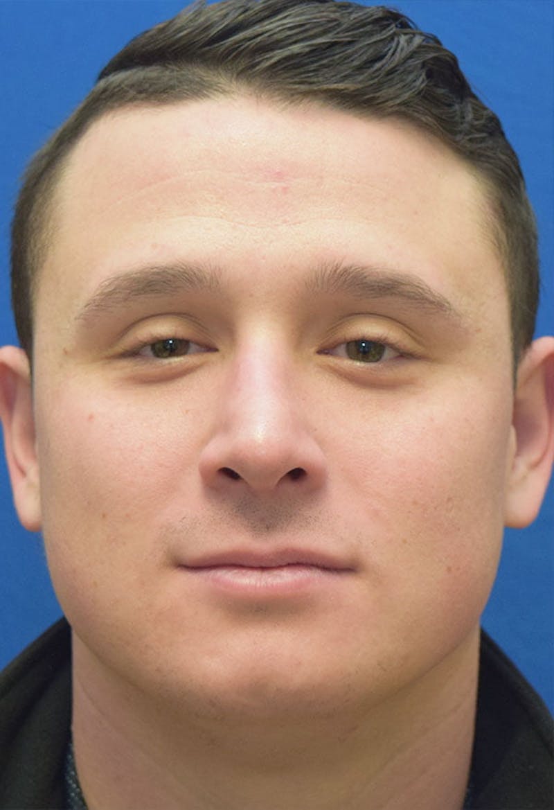 Male Rhinoplasty Before & After Gallery - Patient 112204 - Image 6
