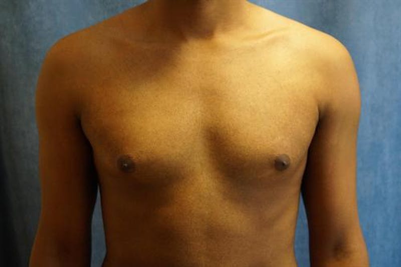 Male Breast Reduction Before & After Gallery - Patient 175961 - Image 1