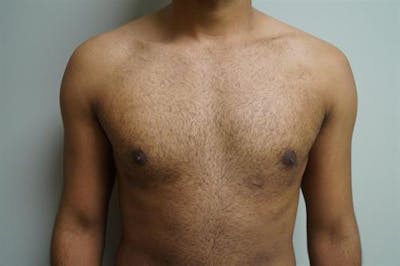 Male Breast Reduction Before & After Gallery - Patient 175961 - Image 2