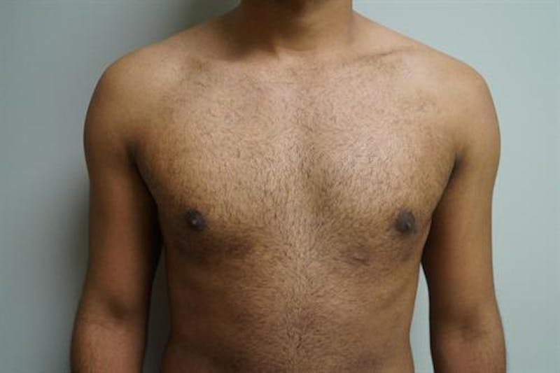 Male Breast Reduction Before & After Gallery - Patient 175961 - Image 2