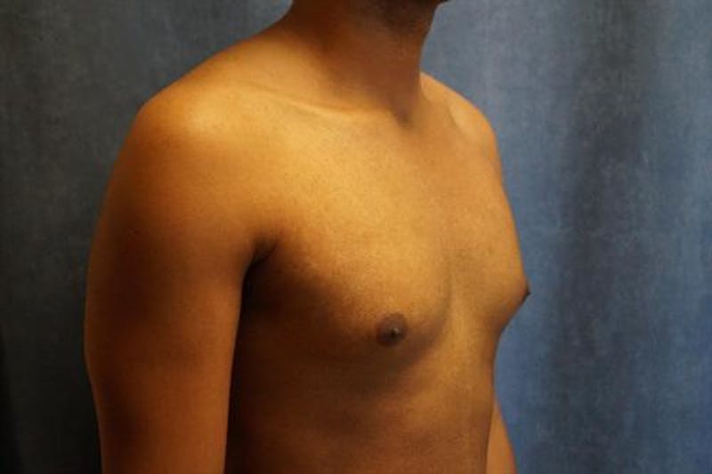 Male Breast Reduction Before & After Gallery - Patient 175961 - Image 3