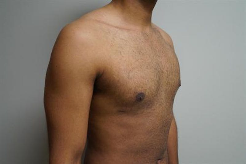 Male Breast Reduction Before & After Gallery - Patient 175961 - Image 4