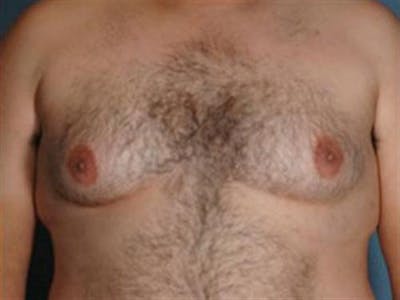 Male Breast Reduction Before & After Gallery - Patient 403263 - Image 1