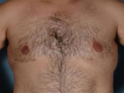 Male Breast Reduction Before & After Gallery - Patient 403263 - Image 2