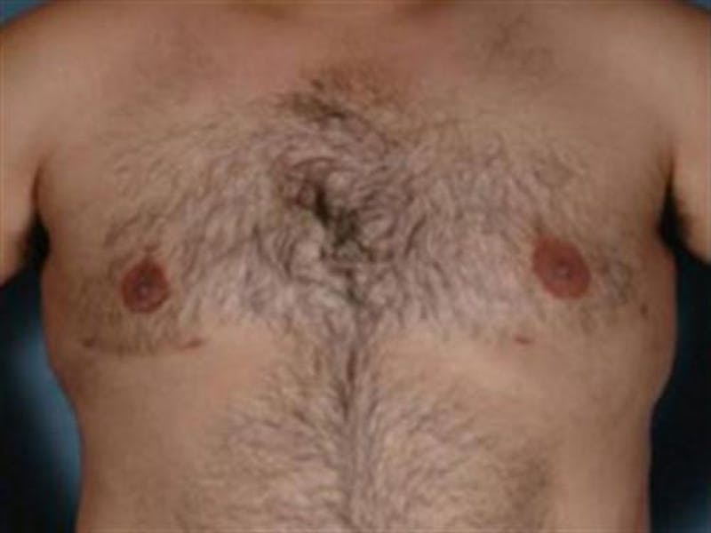 Male Breast Reduction Before & After Gallery - Patient 403263 - Image 2