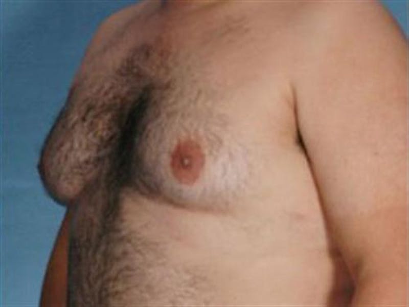 Male Breast Reduction Before & After Gallery - Patient 403263 - Image 3