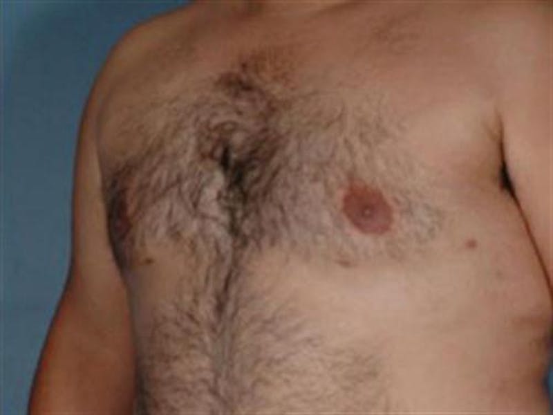 Male Breast Reduction Before & After Gallery - Patient 403263 - Image 4