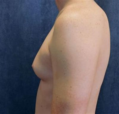 Male Breast Reduction Before & After Gallery - Patient 124965 - Image 1
