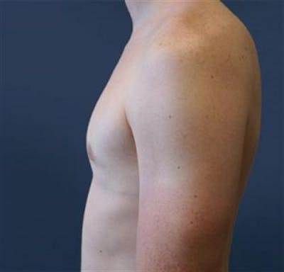 Male Breast Reduction Before & After Gallery - Patient 124965 - Image 2