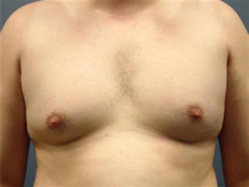Male Breast Reduction Before & After Gallery - Patient 133143 - Image 1