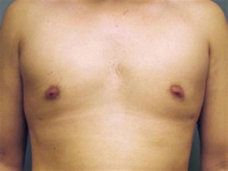 Male Breast Reduction Before & After Gallery - Patient 133143 - Image 2