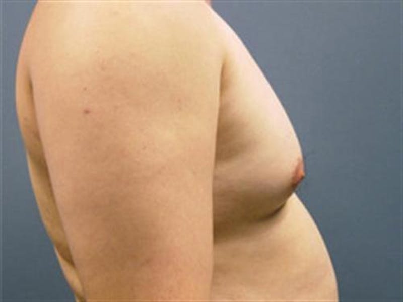 Male Breast Reduction Before & After Gallery - Patient 133143 - Image 3