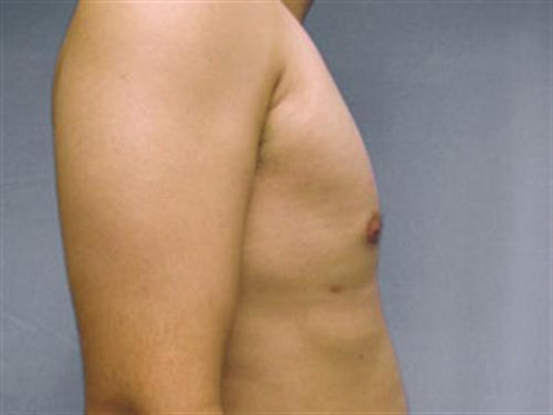 Male Breast Reduction Before & After Gallery - Patient 133143 - Image 4
