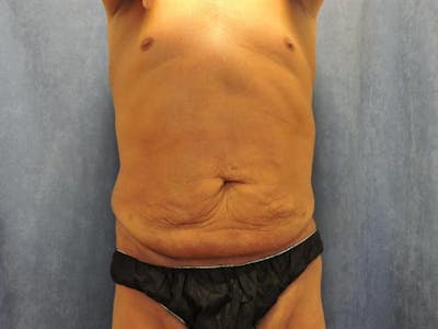 Post Weight Loss Body Contouring Before & After Gallery - Patient 366619 - Image 1