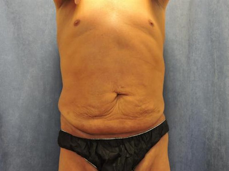 Post Weight Loss Body Contouring Before & After Gallery - Patient 366619 - Image 1