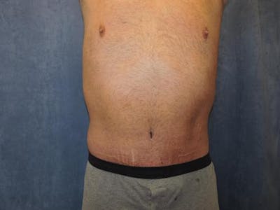 Post Weight Loss Body Contouring Before & After Gallery - Patient 366619 - Image 2