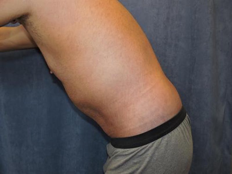 Post Weight Loss Body Contouring Before & After Gallery - Patient 366619 - Image 4