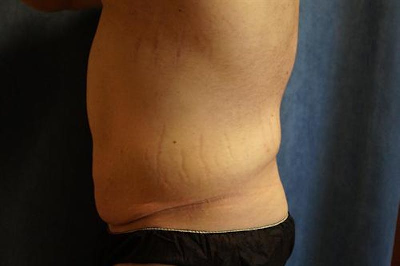 Post Weight Loss Body Contouring Before & After Gallery - Patient 929949 - Image 3
