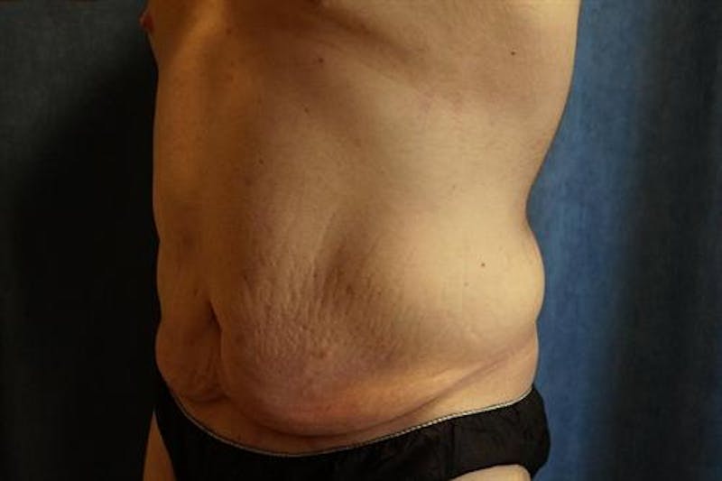 Post Weight Loss Body Contouring Before & After Gallery - Patient 929949 - Image 5