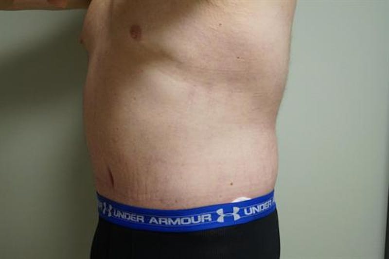 Post Weight Loss Body Contouring Before & After Gallery - Patient 929949 - Image 6