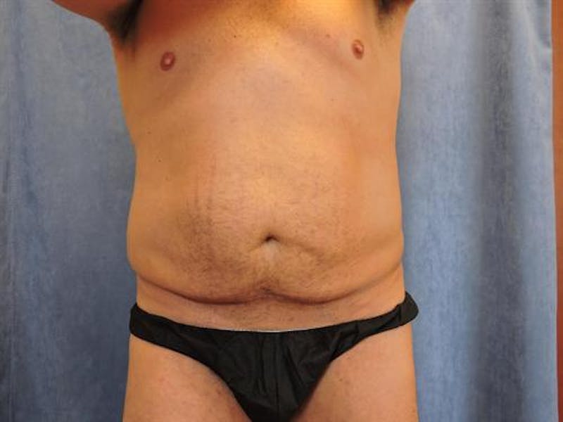 Post Weight Loss Body Contouring Before & After Gallery - Patient 634012 - Image 1