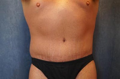 Post Weight Loss Body Contouring Before & After Gallery - Patient 634012 - Image 2