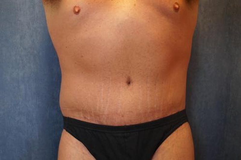 Post Weight Loss Body Contouring Before & After Gallery - Patient 634012 - Image 2