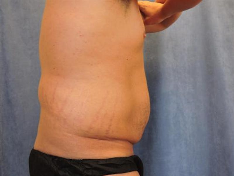 Post Weight Loss Body Contouring Before & After Gallery - Patient 634012 - Image 3