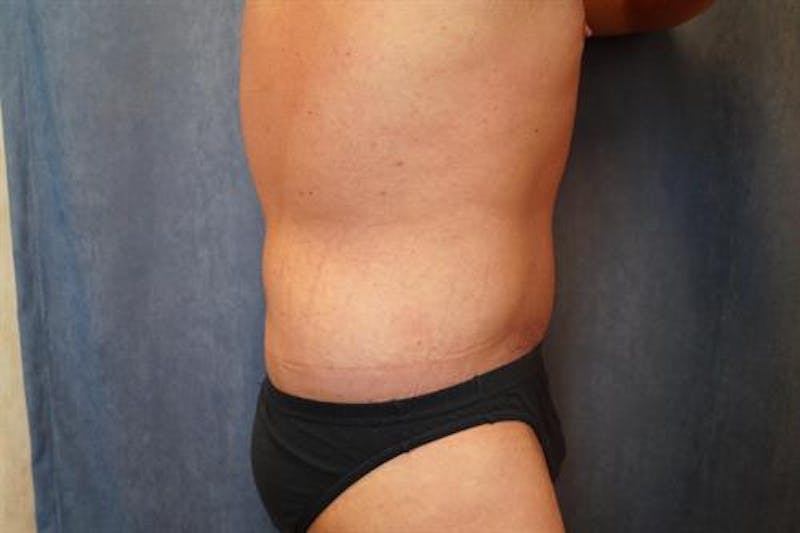 Post Weight Loss Body Contouring Before & After Gallery - Patient 634012 - Image 4