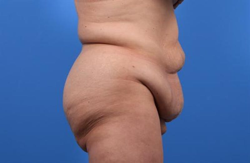 Post Weight Loss Body Contouring Before & After Gallery - Patient 213915 - Image 1