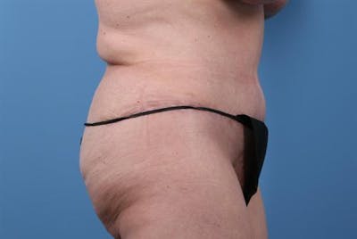 Post Weight Loss Body Contouring Before & After Gallery - Patient 213915 - Image 2