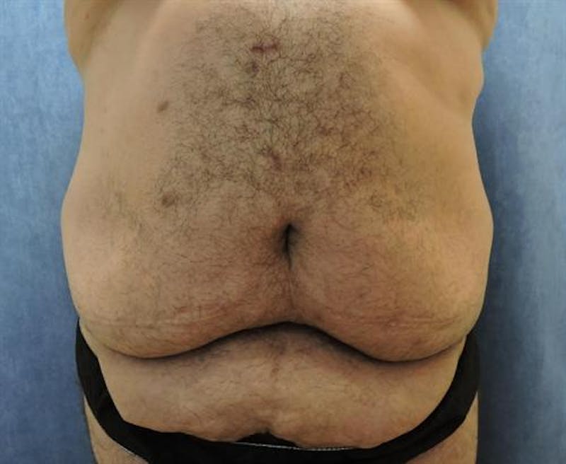 Post Weight Loss Body Contouring Before & After Gallery - Patient 107555 - Image 1