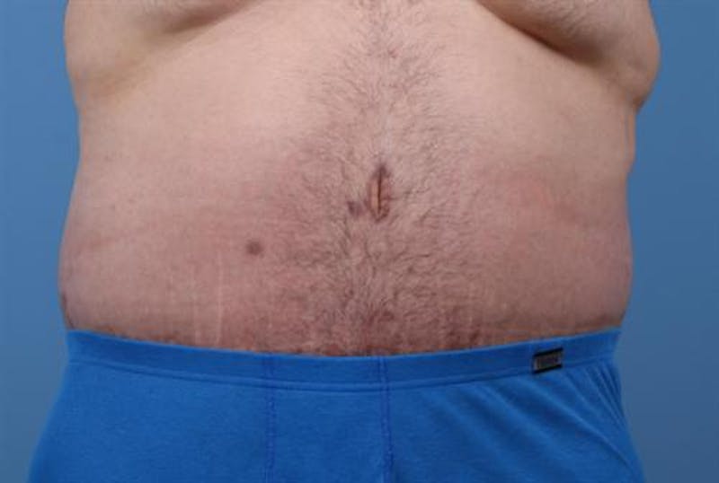 Post Weight Loss Body Contouring Before & After Gallery - Patient 107555 - Image 2