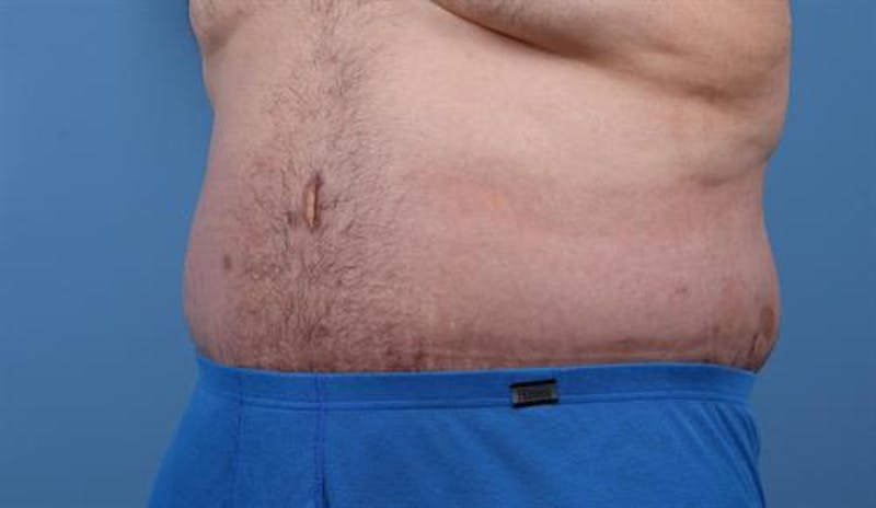 Post Weight Loss Body Contouring Before & After Gallery - Patient 107555 - Image 4