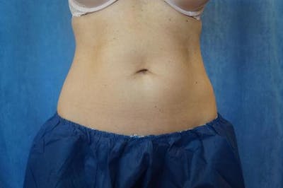CoolSculpting Before & After Gallery - Patient 400632 - Image 1
