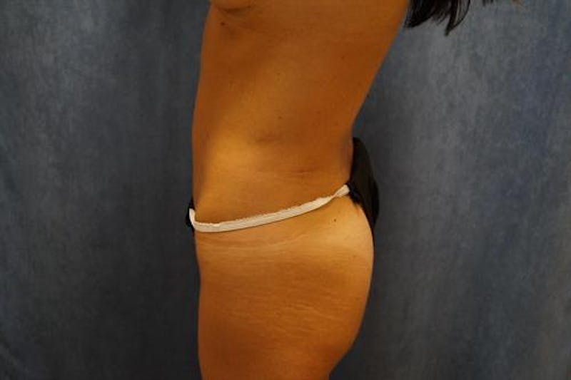 CoolSculpting Before & After Gallery - Patient 400632 - Image 4
