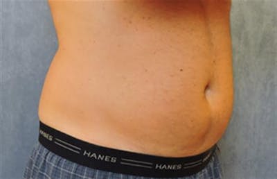 CoolSculpting Before & After Gallery - Patient 396144 - Image 1