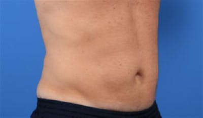 CoolSculpting Before & After Gallery - Patient 396144 - Image 2