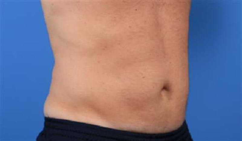 CoolSculpting Before & After Gallery - Patient 396144 - Image 2