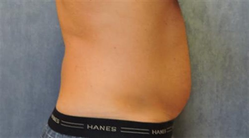 CoolSculpting Before & After Gallery - Patient 396144 - Image 3