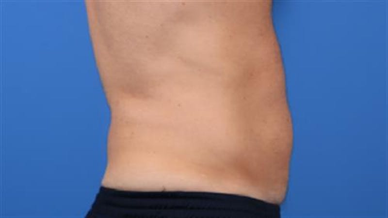 CoolSculpting Before & After Gallery - Patient 396144 - Image 4