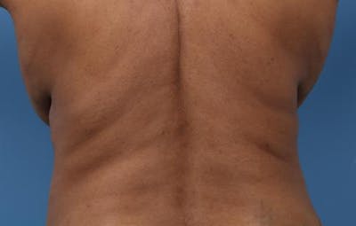 CoolSculpting Before & After Gallery - Patient 367197 - Image 1