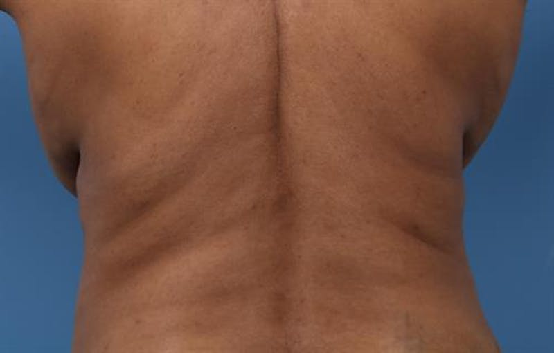 CoolSculpting Before & After Gallery - Patient 367197 - Image 1