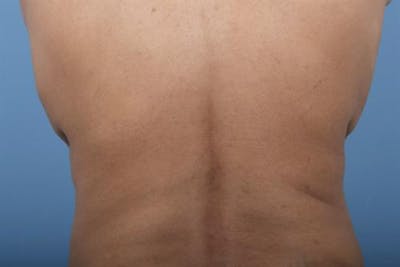 CoolSculpting Before & After Gallery - Patient 367197 - Image 2