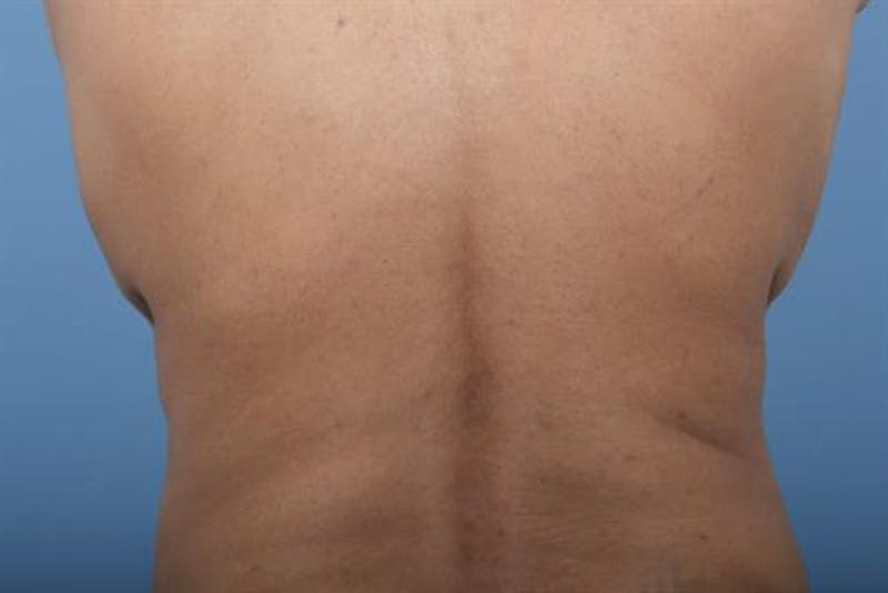 CoolSculpting Before & After Gallery - Patient 367197 - Image 2