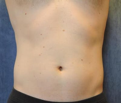 CoolSculpting Before & After Gallery - Patient 130045 - Image 1