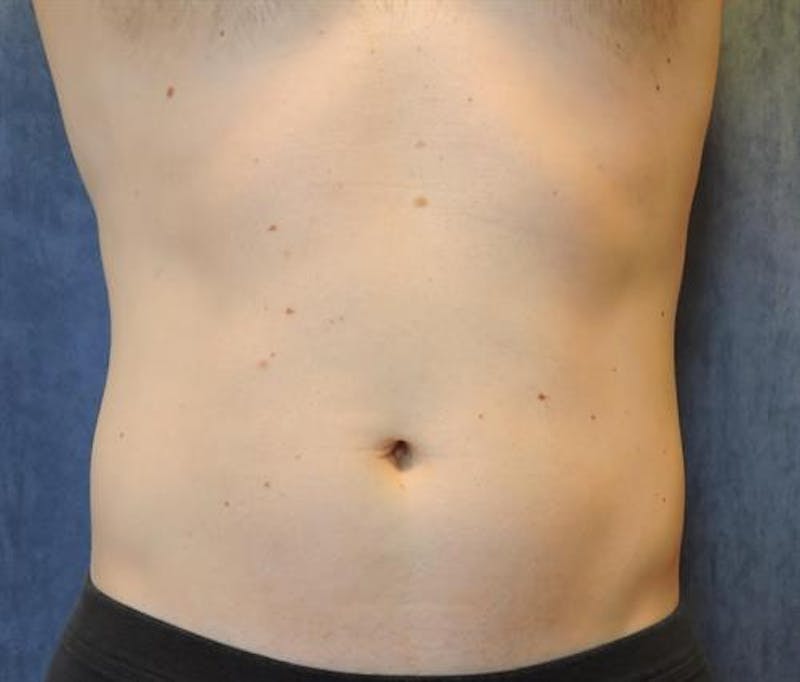CoolSculpting Before & After Gallery - Patient 130045 - Image 1