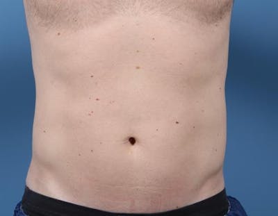 CoolSculpting Before & After Gallery - Patient 130045 - Image 2