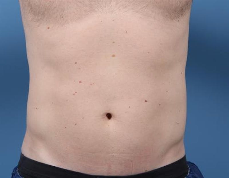 CoolSculpting Before & After Gallery - Patient 130045 - Image 2