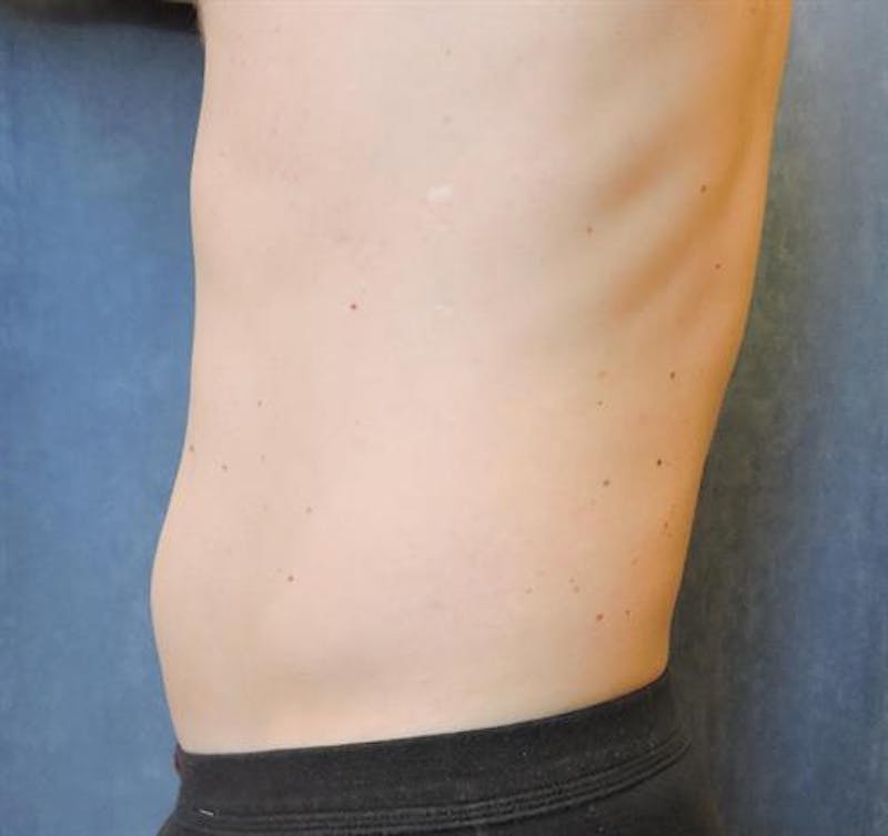 CoolSculpting Before & After Gallery - Patient 130045 - Image 3
